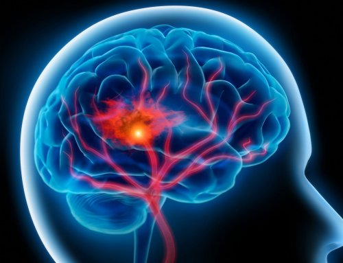 Ischemic Stroke Treatment